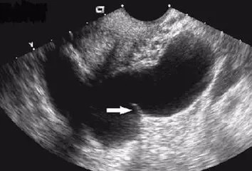 输卵管积水?精子如何趟过这条河?