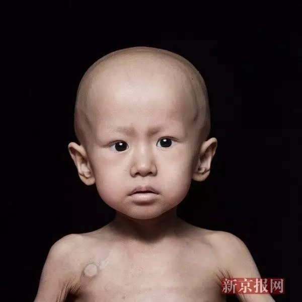 用什么拯救"化疗中的童年"| 新京报快评