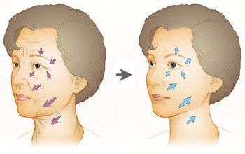 韩国医院面部线雕提升手术 瘦脸提升双功效