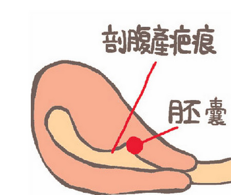 子宫疤痕妊娠有危险吗?什么是剖宫产后子宫疤