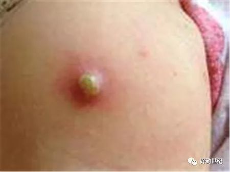 卡介苗化脓后能洗澡吗?在家怎么护理呢?