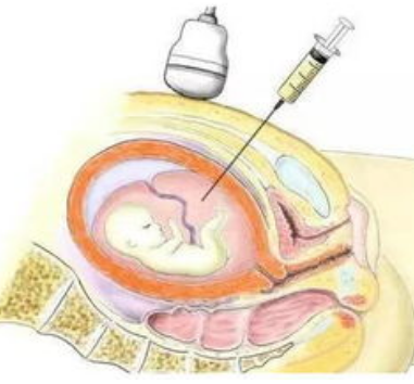 孕期想做胎儿亲子鉴定该怎么办?