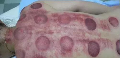 拔罐后皮肤颜色,反应出身体健康的不同问题