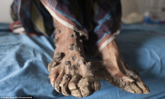 据了解，全世界目前仅有4例这种病例。去年，印度尼西亚一名患这种病的男子已经病逝。他的症状比Abul Bajandar更严重。