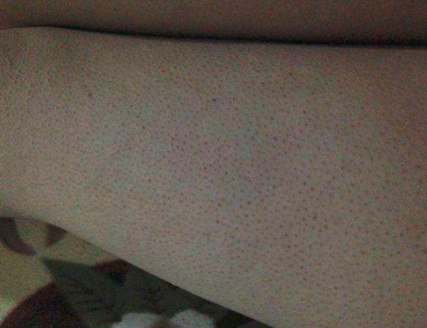 鸡皮肤用什么身体乳好,五点教你重回光滑肌!