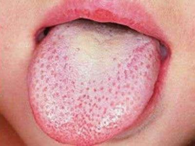 没事伸伸舌头看看舌苔 这些症状要当心