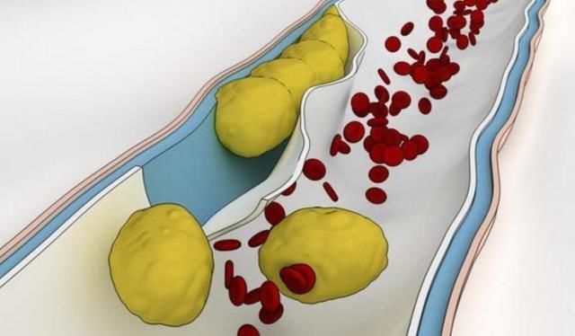 低密度脂蛋白升高后,脑血管会慢慢堵塞,3个饮
