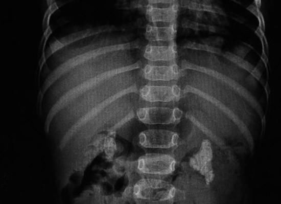 一岁孩子肚子硬邦邦全是结石,只因妈妈总是担