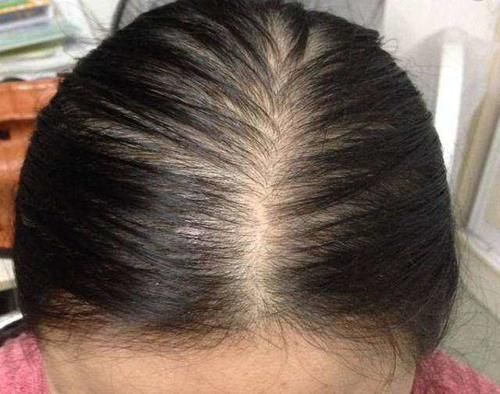 头发油得快,头屑多?可能是螨虫在作祟,洗头时