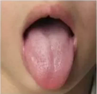 警惕舌头这3种颜色，贴秋膘不乱补