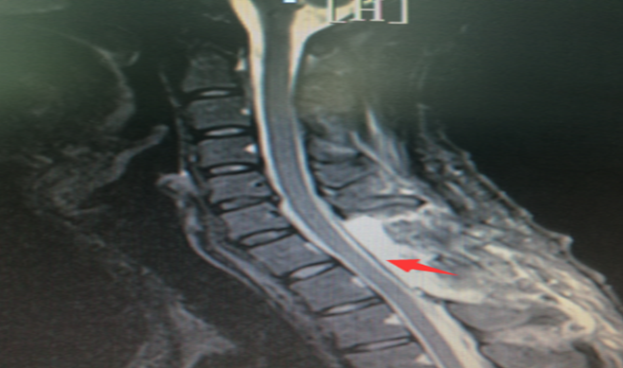 危急三小时 南华医院神经外科专家巧拆颅内定
