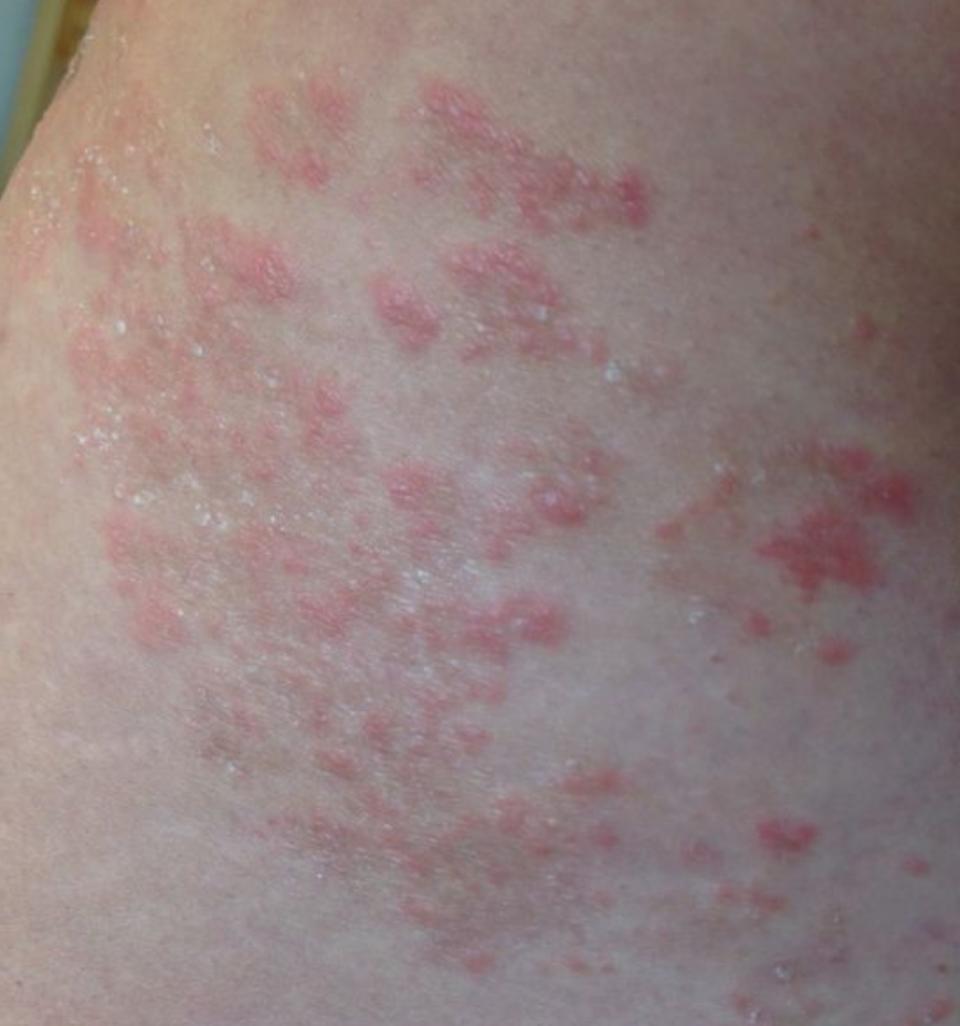 折磨我一年多的股藓,终于好了