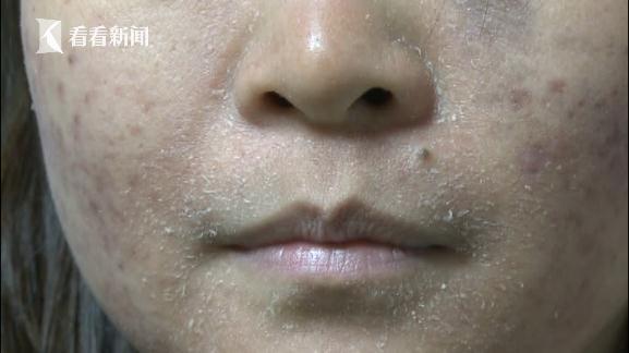 女子美容反而“无脸见人” 老板称是正常排毒 女子美容反而“无脸见人” 老板称是正常排毒