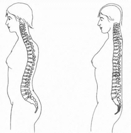 腰椎反弓变直,简单一招轻松解决!