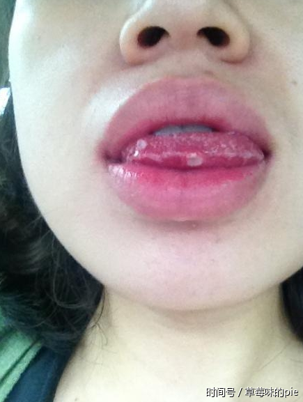 家里的这个东西让口腔溃疡越来越难忍,九成人