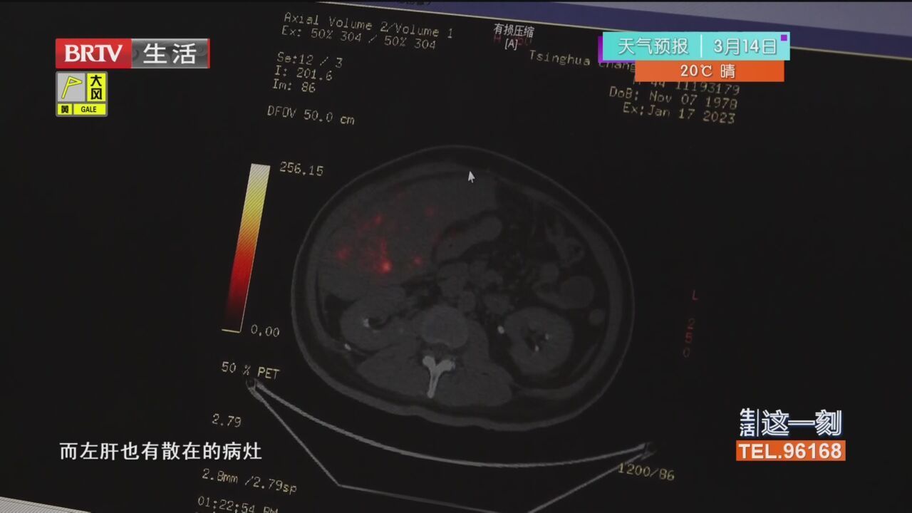 肝部发现巨型肿瘤 尝试新治疗技术重燃生活希望