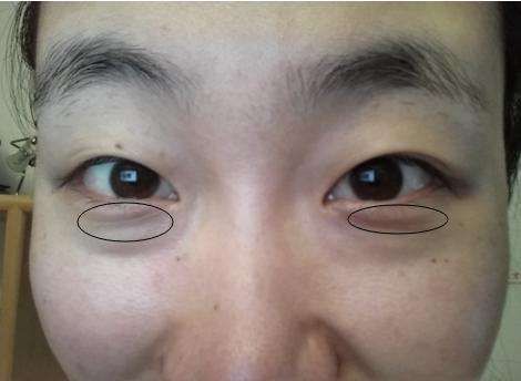 高龄皮肤主任告诉我:药店常见的药膏、用上3天