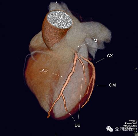 pd 左室后支 posterior branches of leftventricular pl 锐缘支