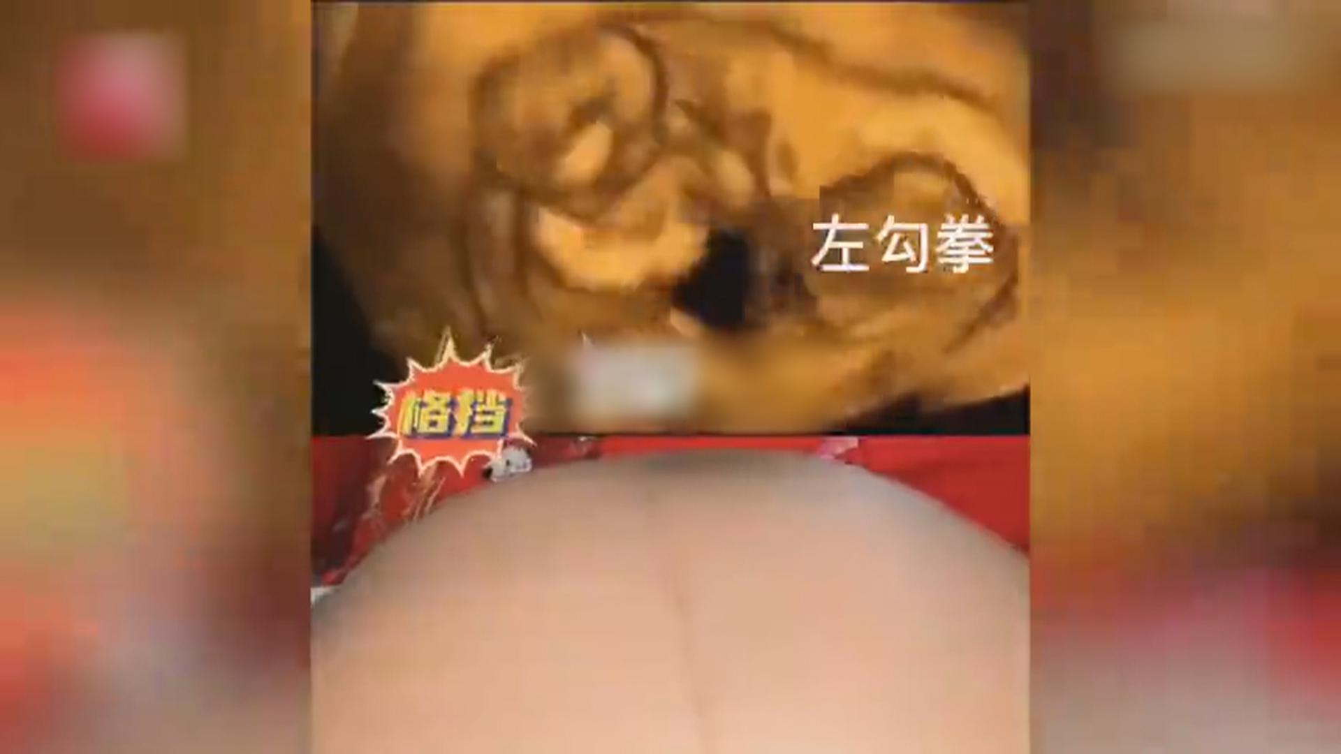 双胞胎在肚里打架致淤青？专家辟谣！短视频造假 这股歪风要刹住！