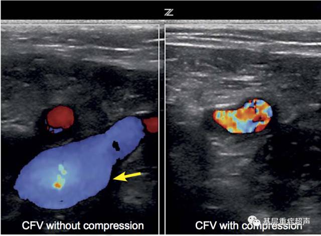 深静脉血栓(关键字:股静脉;腘静脉;股总静脉) 深静脉血栓(关键字:股静脉;腘静脉;股总静脉)