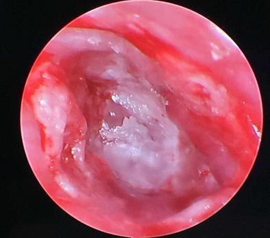浙江5岁男孩掏颗耳屎花了5000元 医生:硬得像水泥 浙江5岁男孩掏颗耳屎花了5000元 医生:硬得像水泥