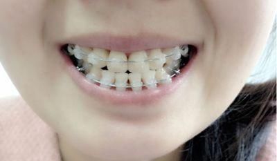 牙齿矫正器哪种便宜又好、性价比高?