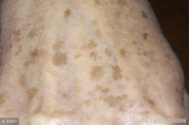 为什么年轻人也会长老年斑?还不是这4个原因