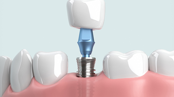 多地种植牙价格调控政策将实施，业内称市场需求将进一步释放