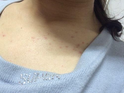 女孩胸前背后长痘痘6年不敢穿裙子 医生竟这样