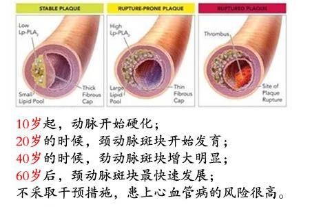 心梗与脑中风是猝死原因,但罪魁祸首是它,有哪