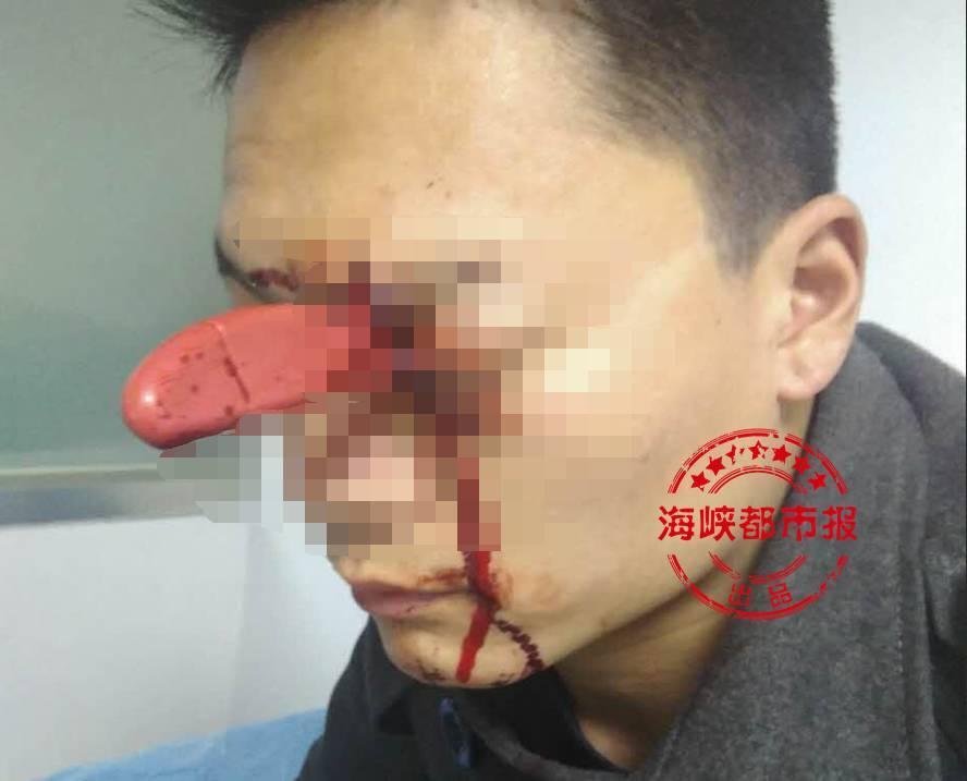 男子头插水果刀 淡定排队就诊