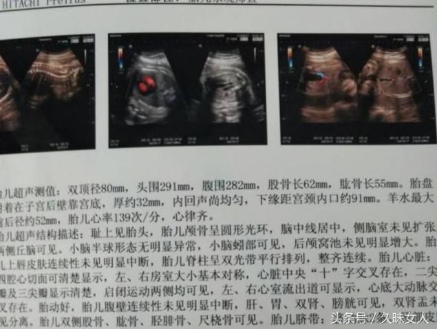 怀孕32周男宝宝B超图,孕期肚型分享