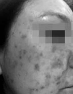 女子花三万美容变毁容,从业十年的美容师揭秘