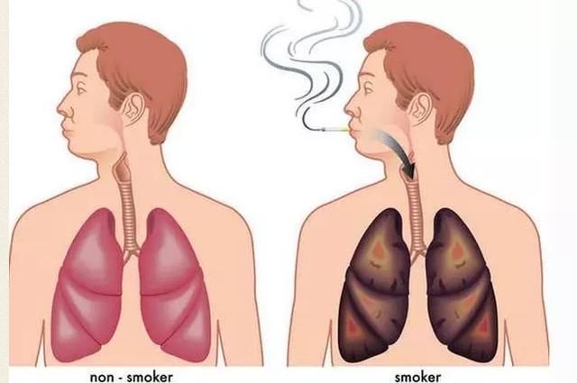 吸烟多久后,肺会变黑?戒烟后,肺还能恢复正常