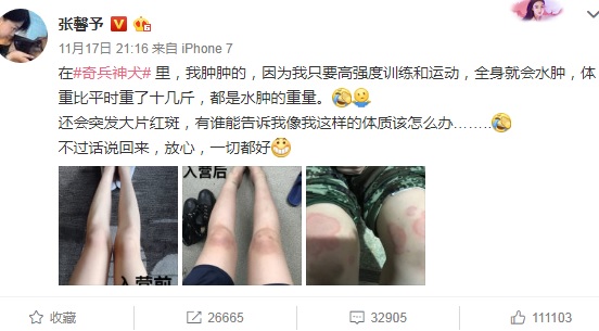 张馨予拍综艺节目闹一身病 全身水肿长红斑