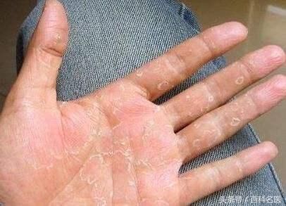 手脱皮是身体缺什么维生素?这些原因都可能导