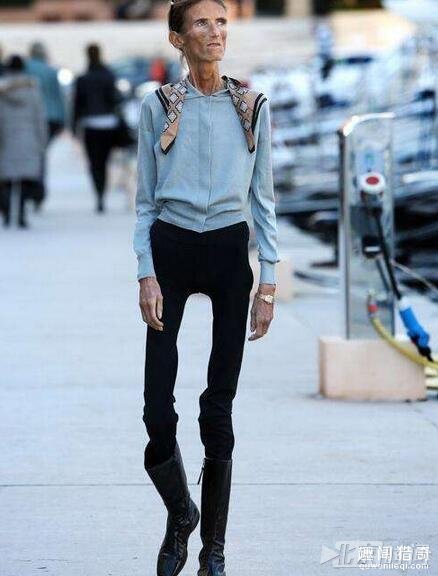 女子减肥过度瘦成骷髅人 那么漂亮的她回不去了