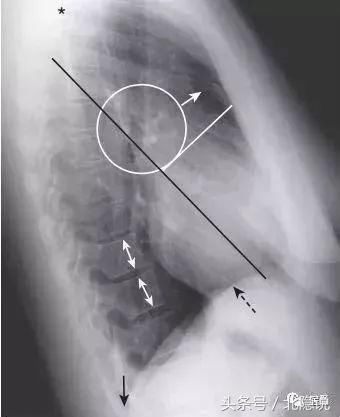 X线侧位胸片的诊断关键看这5个地方!帮你总结