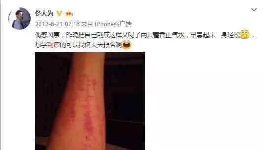 贾乃亮杨幂拔罐,刘涛佟大为刮痧,看大明星们都