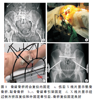 骨盆環骨折的治療策略 雪花新闻