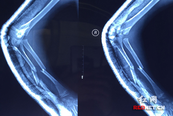 x光片显示肘关节扭曲,前臂粉碎性骨折.