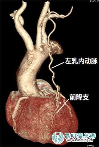 患者出院前在博亚医院复查冠脉ct,乳内动脉桥良好