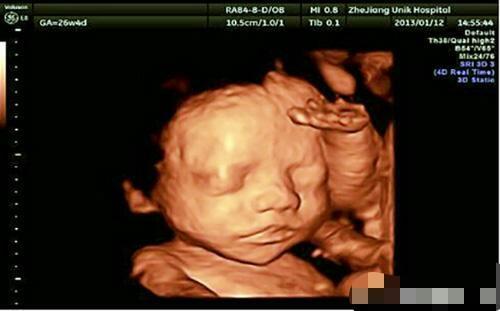 孕妈B超显示女宝，手术后发现是男胎，亲手葬送了儿子