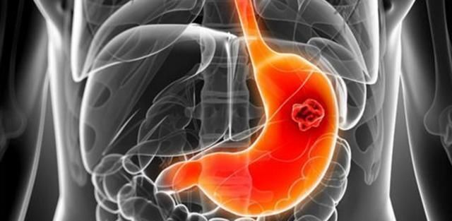 一两黄芪胜过10副药 专治胃疼胃胀 1吃1个好 胃