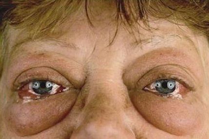 吃货拯救大眼袋,无意中发现厨房中的食材,压碎敷眼,一夜眼袋消失-北京