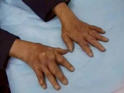 降尿酸药能溶解尿酸盐结晶、痛风石吗?(图2) 降尿酸药能溶解尿酸盐结晶、痛风石吗?(图2)