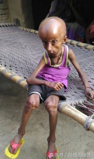 印度男青年患罕见早衰症,21岁的他拥有160岁老人身体