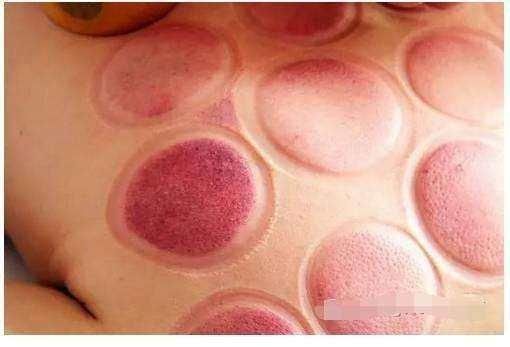 拔罐后留下的罐印,真的能说明身体存在问题吗