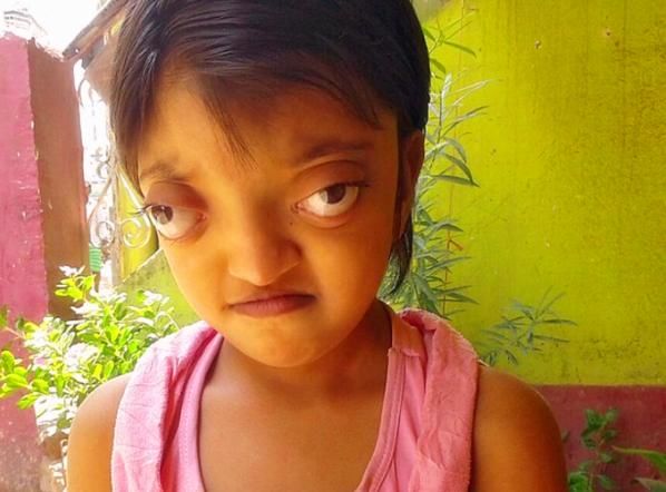 印度女孩长了一双"青蛙眼",受同学排挤,仍然乐观面对生活
