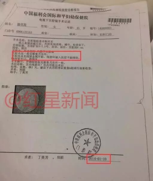 女子遭强行安环后残片留体内26年 被切子宫卵